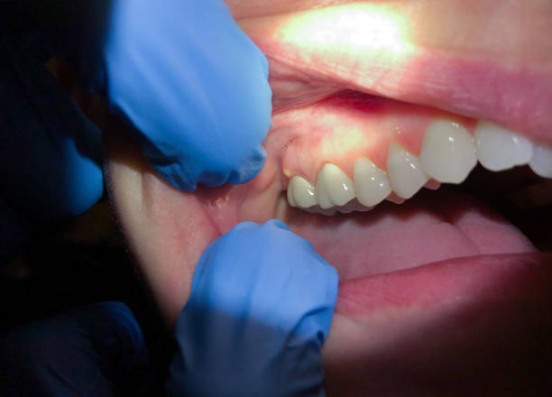 Best Emergency Denture Repair in Helper, UT